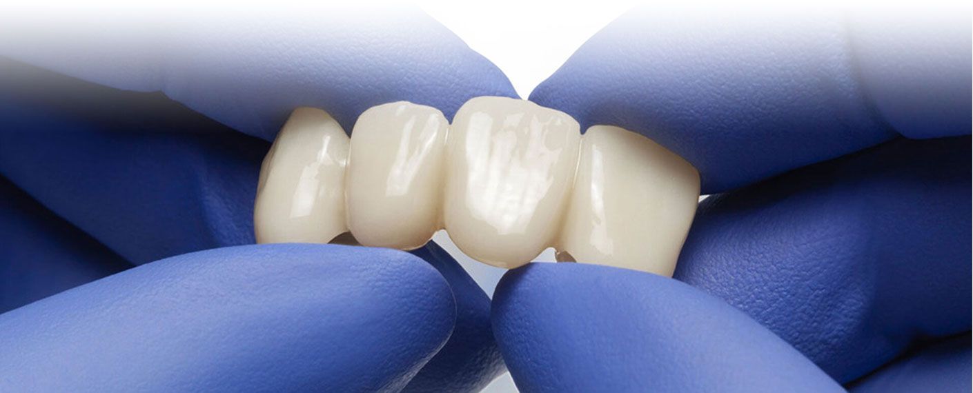 Waar en hoe overtuigt IPS e.max ZirCAD Prime?